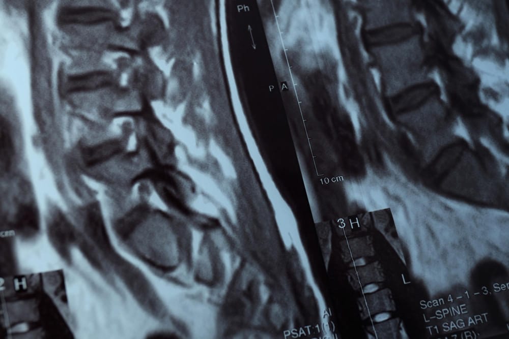 MRI scan of a lumbar spine